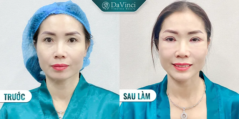 Bao nhiêu tuổi được cắt mí? Tiêu chuẩn độ tuổi & lưu ý quan trọng Bao nhiêu tuổi được cắt mí? Tiêu chuẩn độ tuổi & lưu ý quan trọng