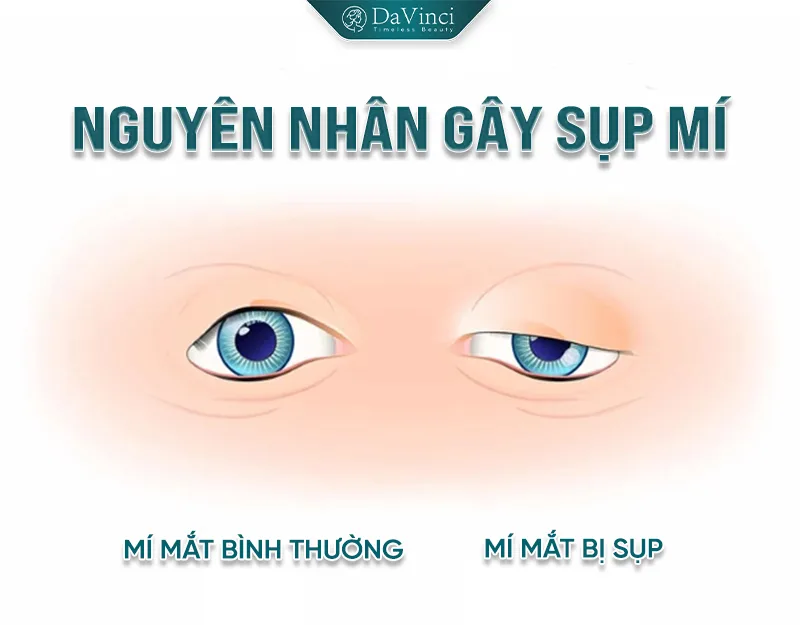 Cách chống sụp mí mắt hiệu quả: Bí quyết cho đôi mắt trẻ trung
