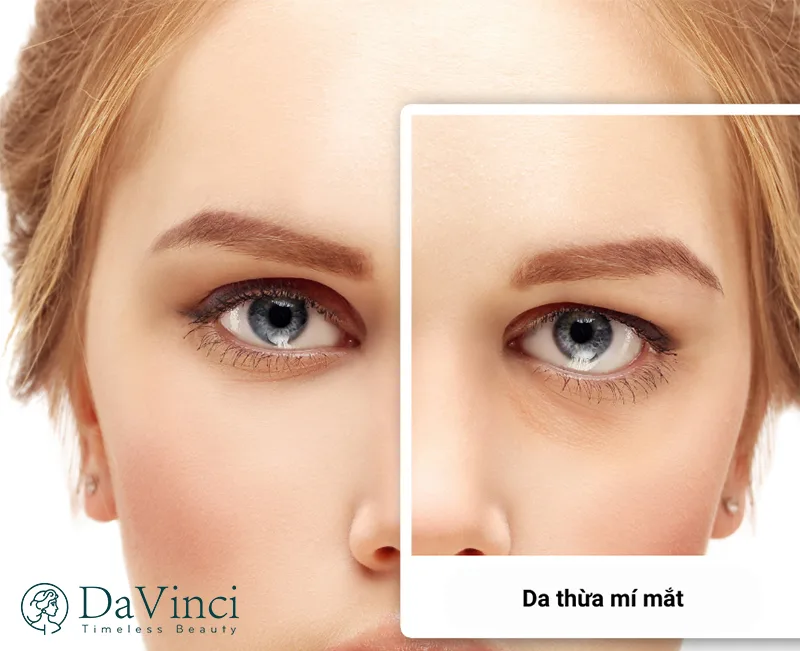 Cắt da thừa mí mắt ở đâu đẹp và uy tín? 
