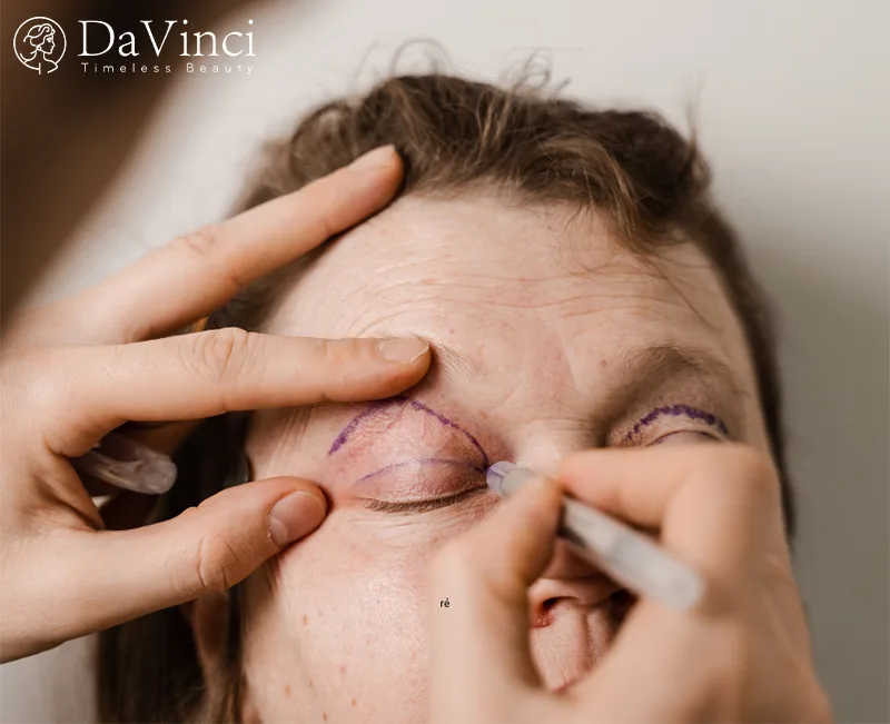 Cắt da thừa mí mắt ở đâu đẹp và uy tín? 