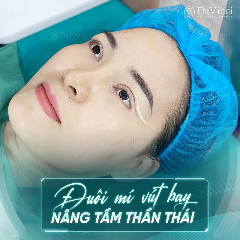 Cắt Mí Kiêng Trứng Bao Lâu? Cách Thực Hiện Đúng Để Hạn Chế Sẹo