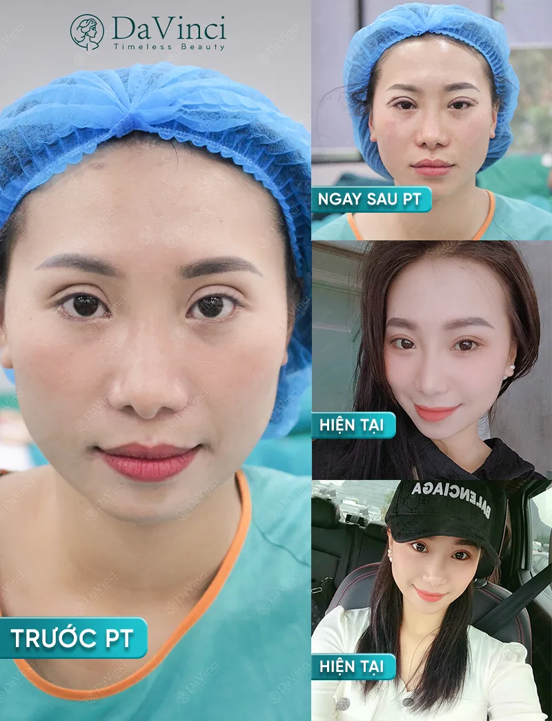 Cắt mí mắt bao lâu thì hết sưng? Hướng dẫn hồi phục chi tiết Cắt mí mắt bao lâu thì hết sưng? Hướng dẫn hồi phục chi tiết