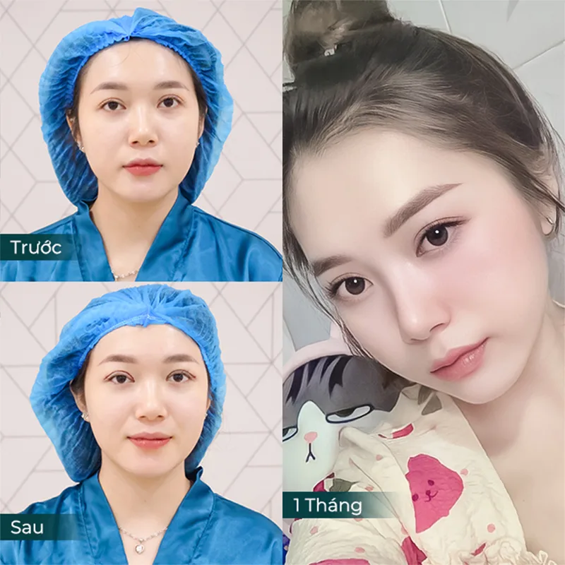 Cắt Mí Mắt: Có Thực Sự Thay Đổi Vận Mệnh Của Bạn Không?
