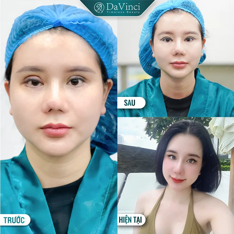 Cắt Mí Mắt: Có Thực Sự Thay Đổi Vận Mệnh Của Bạn Không?