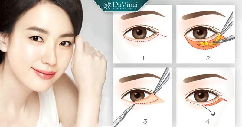 Cắt mí dưới có hết nhăn không? Giải đáp chuyên gia & hiệu quả