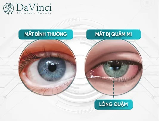 Phẫu thuật quặm mi mắt bao nhiêu tiền? So sánh giá & nơi thực hiện