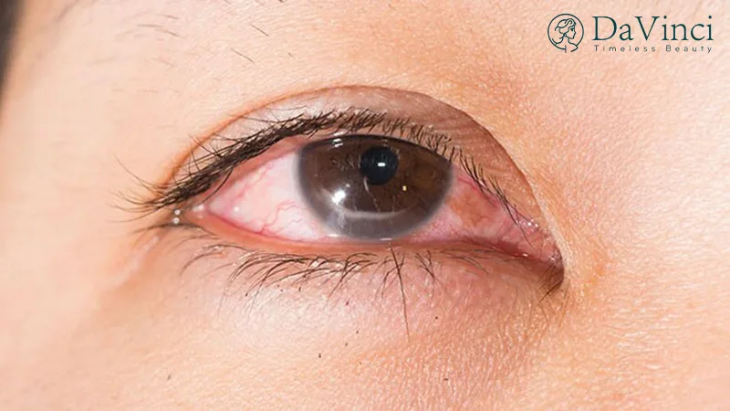 Phẫu thuật quặm mi mắt bao nhiêu tiền? So sánh giá & nơi thực hiện