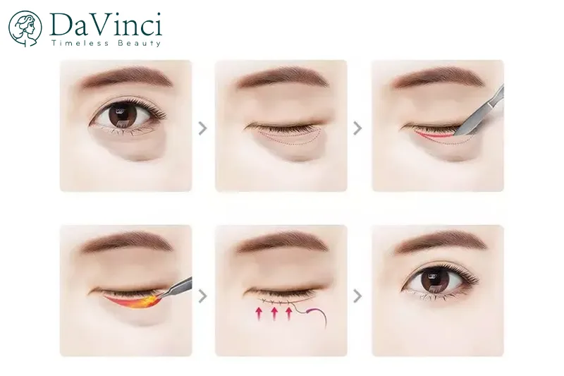 Kinh nghiệm cắt bọng mỡ mắt: Chia sẻ chuyên gia & review thực tế Kinh nghiệm cắt bọng mỡ mắt: Chia sẻ chuyên gia & review thực tế