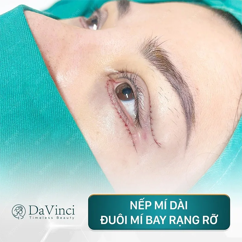 Lấy mỡ bọng mắt có bị lại không? Cắt bọng mắt dưới ở đâu tốt nhất?