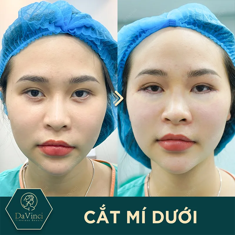 Lấy mỡ bọng mắt dưới bao lâu thì lành? Hướng dẫn quá trình hồi phục Lấy mỡ bọng mắt dưới bao lâu thì lành? Hướng dẫn quá trình hồi phục