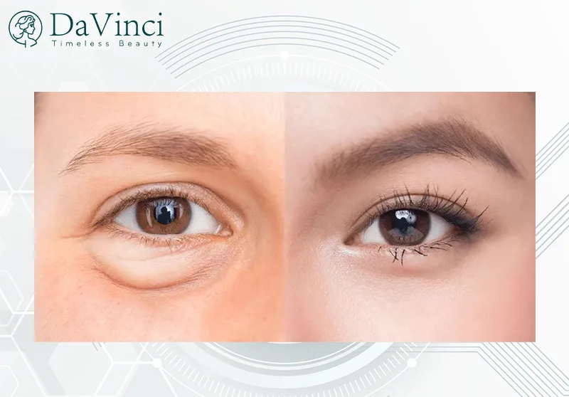 Lấy mỡ bọng mắt dưới bao lâu thì lành? Hướng dẫn quá trình hồi phục Lấy mỡ bọng mắt dưới bao lâu thì lành? Hướng dẫn quá trình hồi phục