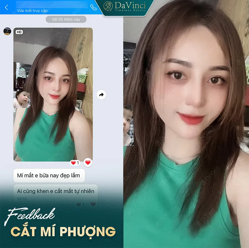 Nâng mí mắt bị sụp giá bao nhiêu? Bảng giá & lưu ý quan trọng