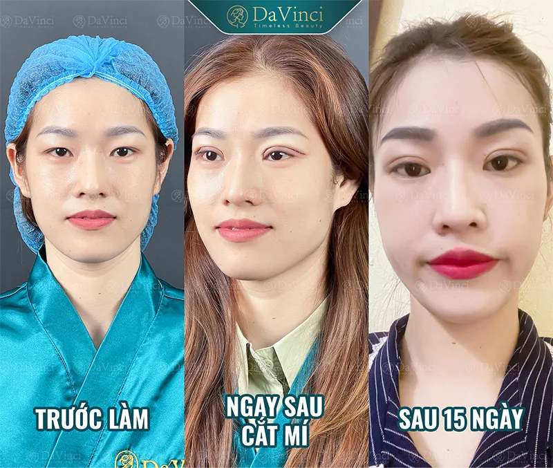 Nâng mí mắt bị sụp giá bao nhiêu? Bảng giá & lưu ý quan trọng