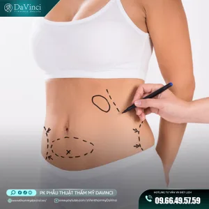 Hút Mỡ Siêu Nét (Hi Def Liposuction)