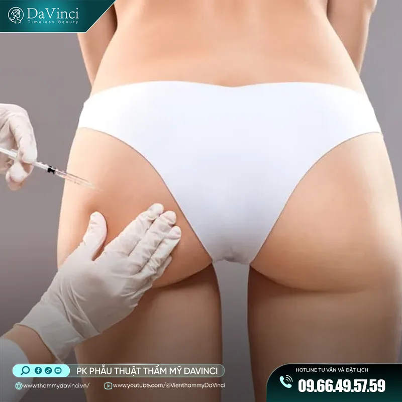 Nâng Mông Bằng Cấy HA Toàn Phần