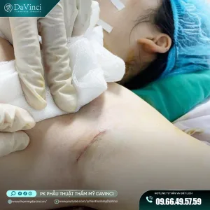 Nâng Ngực Đặt Túi Qua Đường Nách