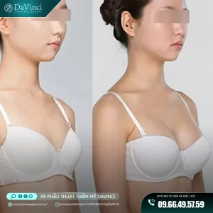 Cấy mỡ ngực