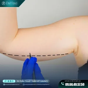 Hút mỡ bắp tay: