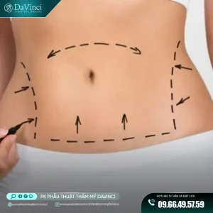 Hút mỡ vùng bụng