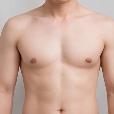 Ngực phì đại ở nam giới