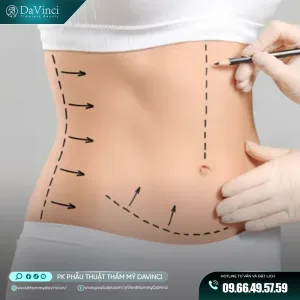 Tạo Hình Thành Bụng Mini: