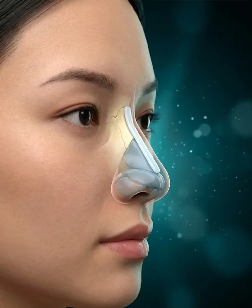 Nâng mũi sụn nhân tạo