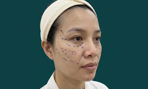 Trước
