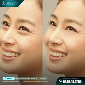 bóc mỡ mí mắt