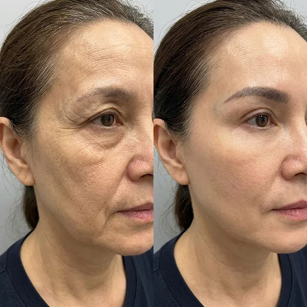 Trước sau căng da thái dương