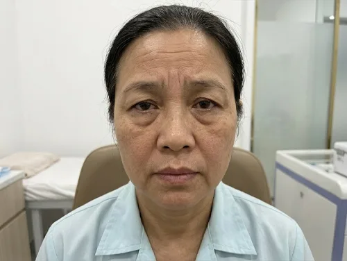 Căng da trán - trước