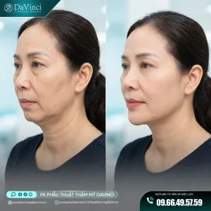 độn cằm bằng ha