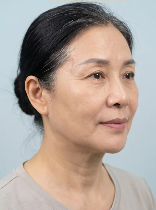 Độn cằm HA - sau