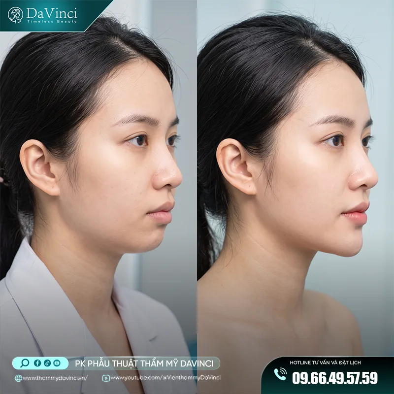 độn cằm hàn quốc