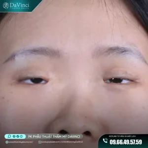 Hội chứng hẹp khe mi