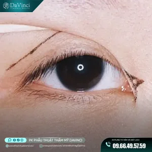 Mở góc mắt trong