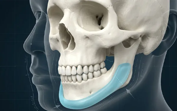 Mô phỏng vị trí đặt chất liệu độn cằm