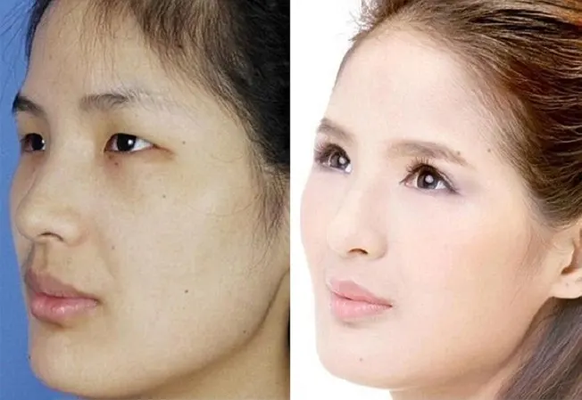 Phụ nữ Trung Quốc đổ sang Hàn Quốc phẫu thuật thẩm mỹ