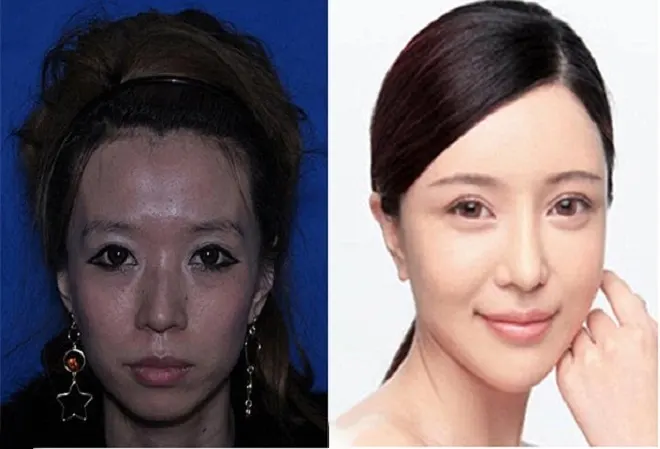 Phụ nữ Trung Quốc đổ sang Hàn Quốc phẫu thuật thẩm mỹ