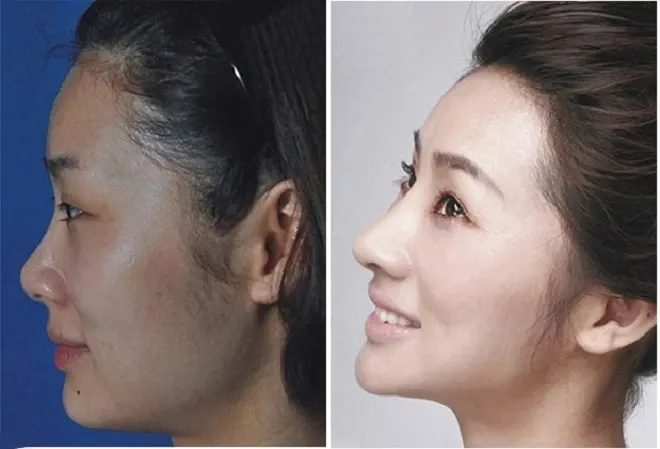 Phụ nữ Trung Quốc đổ sang Hàn Quốc phẫu thuật thẩm mỹ