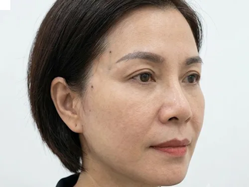 Sau khi căng da bằng chỉ