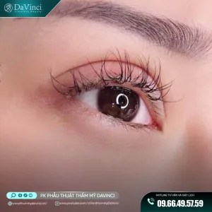 Thẩm mỹ mắt to