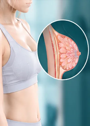 Minh họa cấu trúc mô ngực khi phì đại