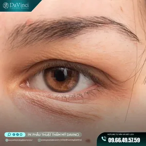 Xóa rãnh lệ mi dưới